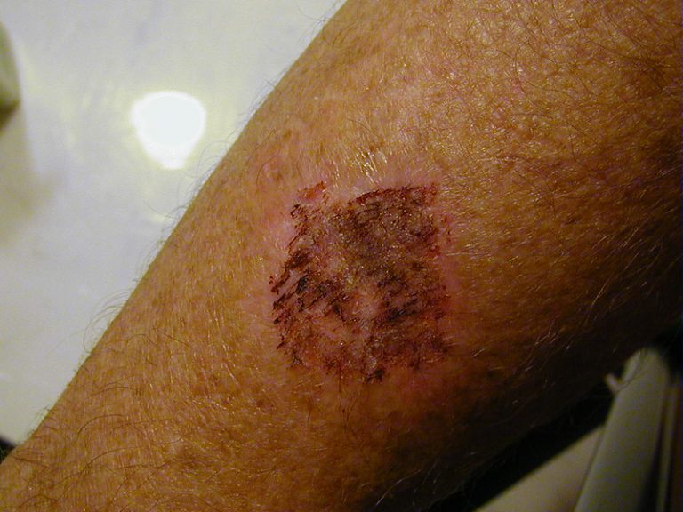 Tattoo Ink Allergy Signs, Symptoms and Cures Tattoo Moisturiser