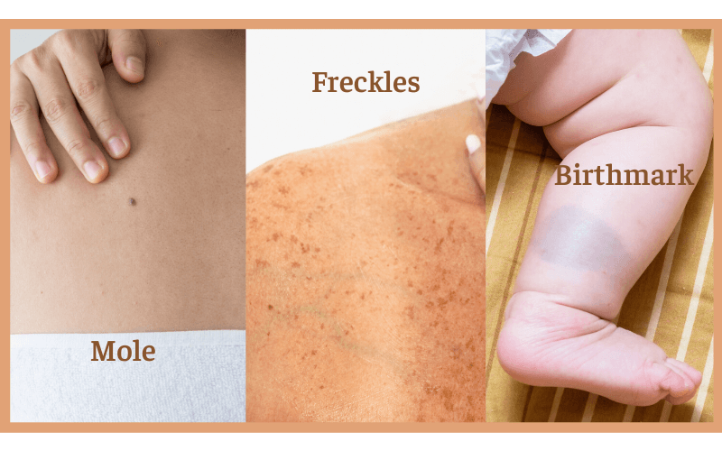 getting a tattoo over moles, freckles and birthmarks